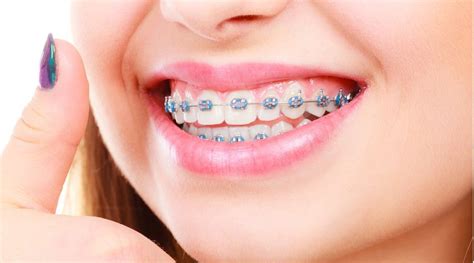 cuanto cuesta ponerse brackets